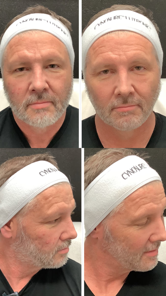 Genius RF Microneedling before and after