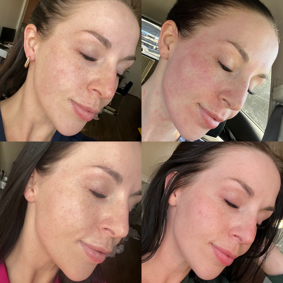 Ultra LaseMD before and after