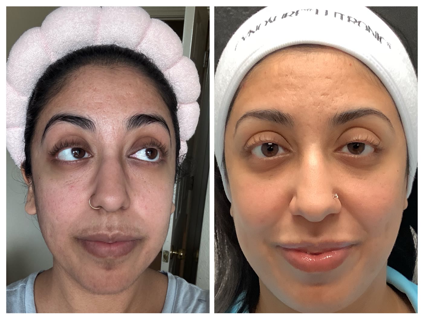 Ultra LaseMD before and after