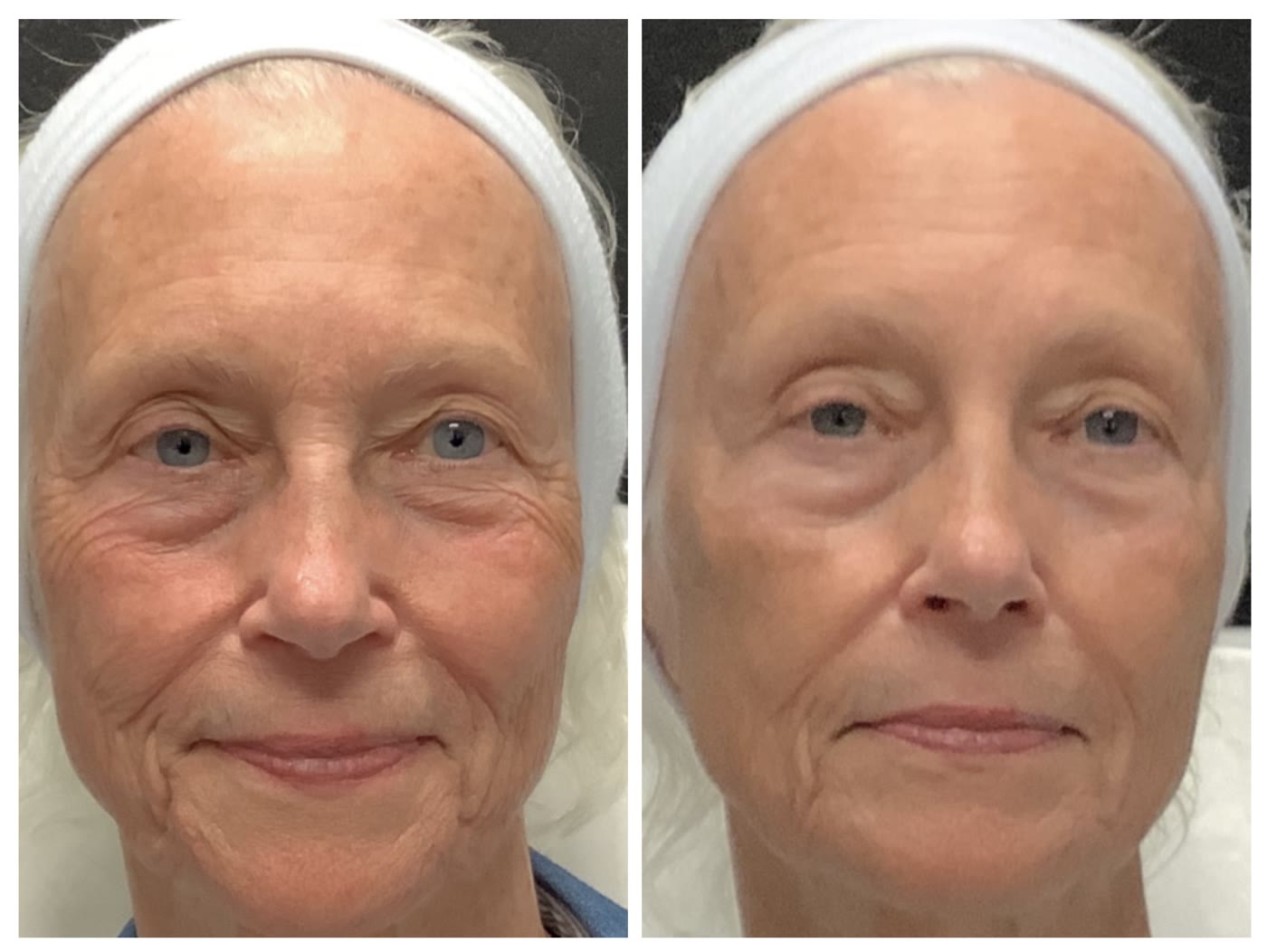 Ultra LaseMD before and after