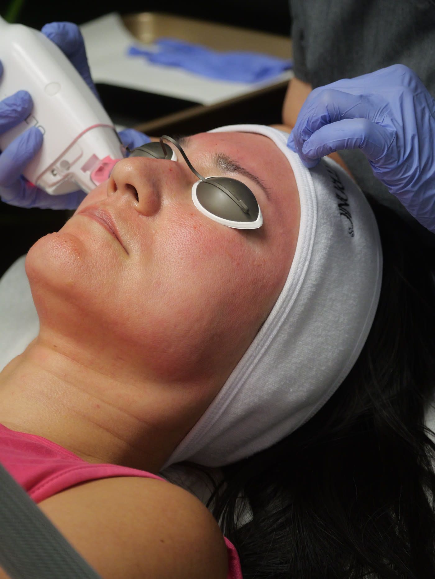 Ultra LaseMD laser resurfacing treatment